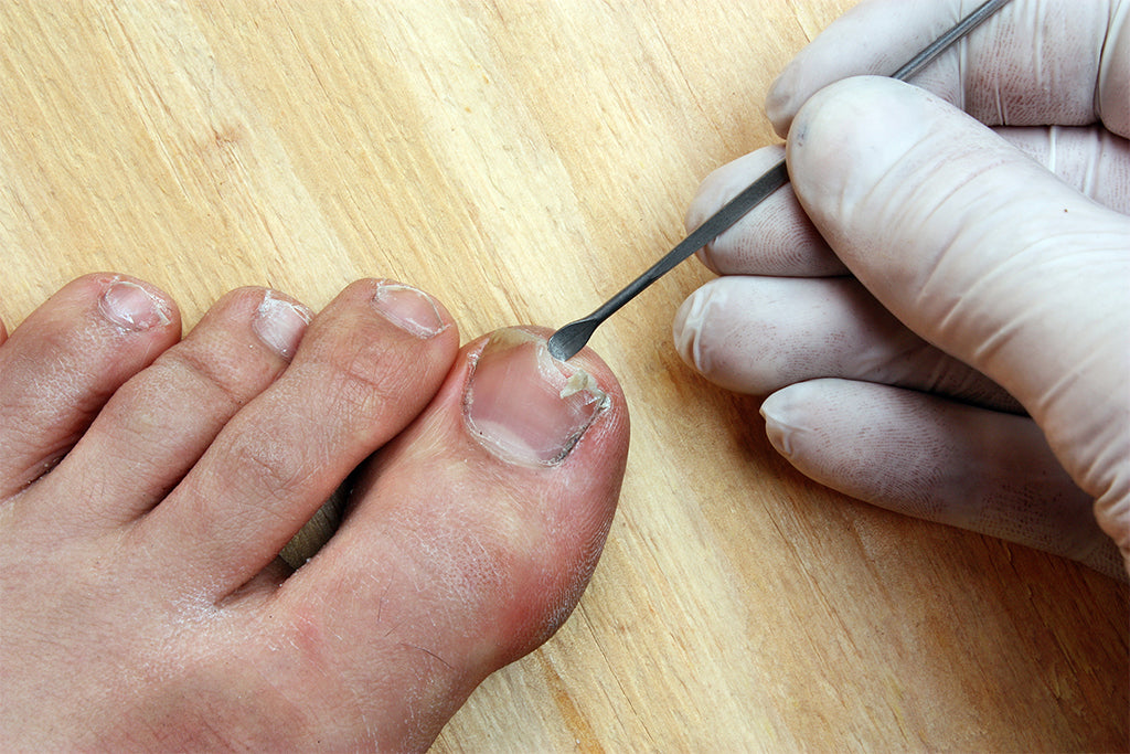 How to Get Rid of Ingrown Fingernails