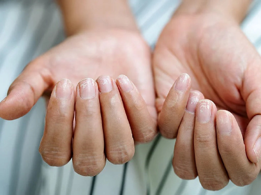 What Causes Brittle Nails with Ridges